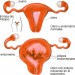 Pólipos uterinos Pólipos uterinos