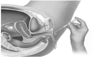 estimulación ovárica