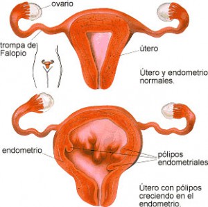 Pólipos uterinos: qué son y cómo afectan a la fertilidad