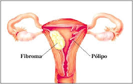 Información sobre los pólipos uterinos - IMFER MURCIA