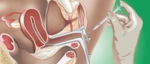 Inseminación artificial: qué es, cómo funciona y cuándo se recomienda