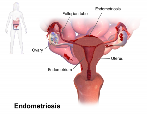 Endometriosis: síntomas, diagnóstico e infertilidad