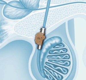 Anticonceptivo masculino reversible: el interruptor testicular
