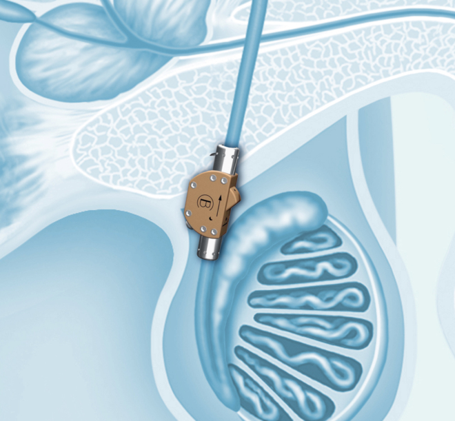 Anticonceptivo masculino reversible: el interruptor testicular