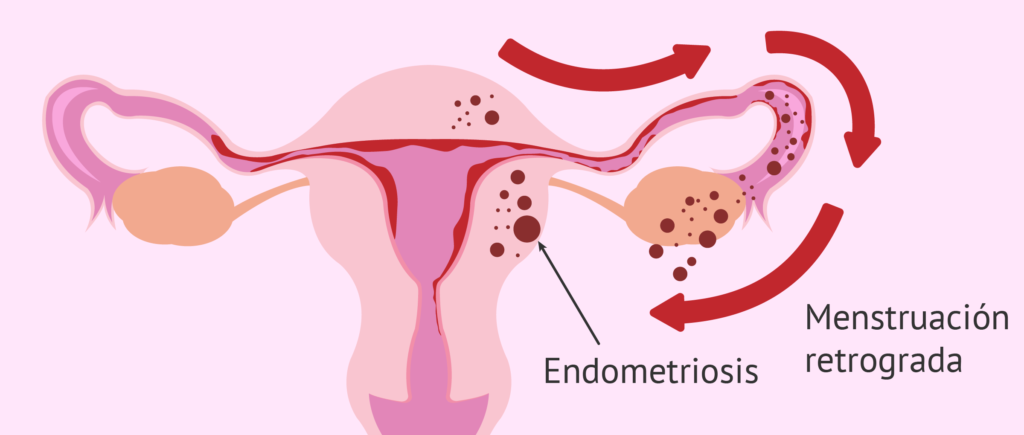 Síntomas de endometriosis que no debes ignorar: detección precoz y diagnóstico actual